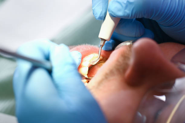 Best Emergency Dental Care for Broken or Chipped Teeth in Scottsboro, AL