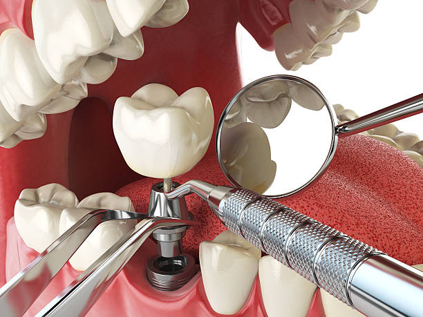 Best Emergency Tooth Extraction in Scottsboro, AL